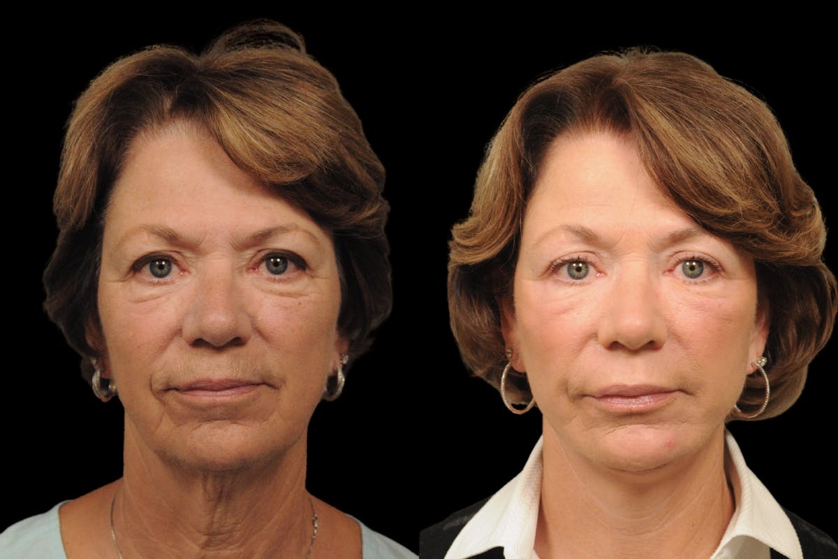 Changes Rapid Lift  Before & After Gallery - Patient 371576 - Image 5