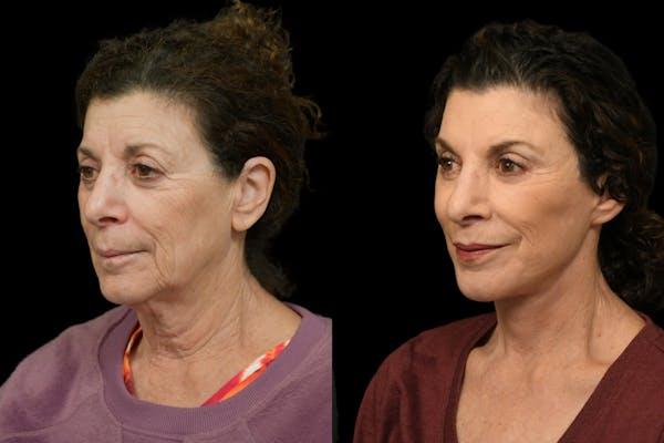 Changes Rapid Lift  Before & After Gallery - Patient 110229 - Image 1