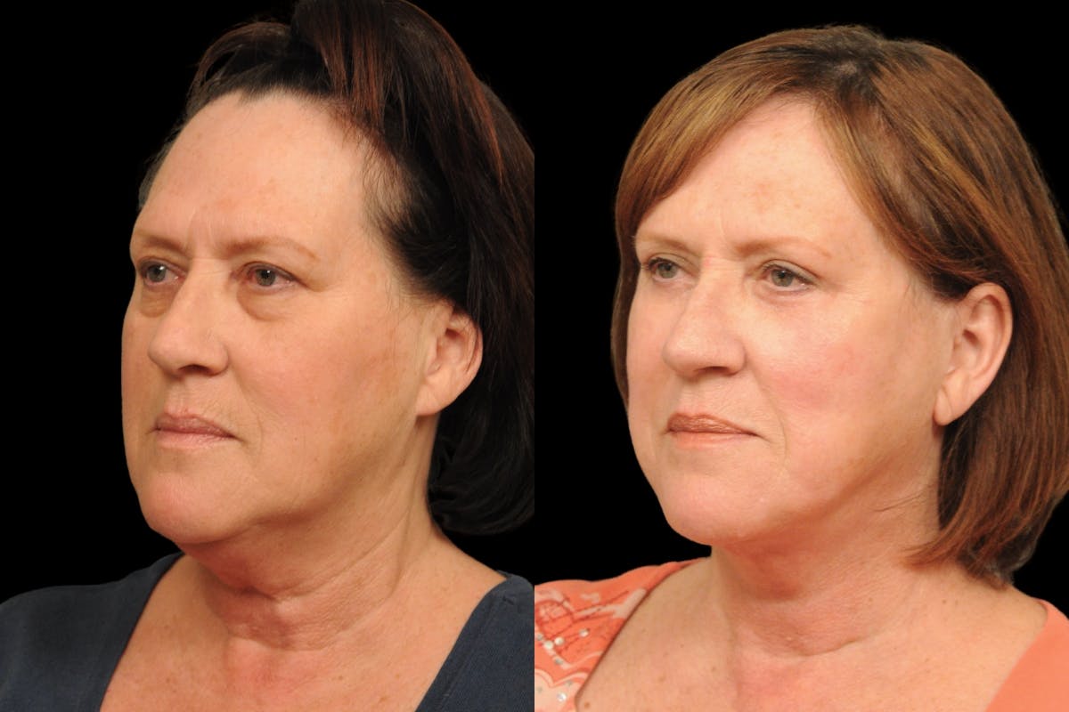 Changes Rapid Lift  Before & After Gallery - Patient 136713 - Image 1