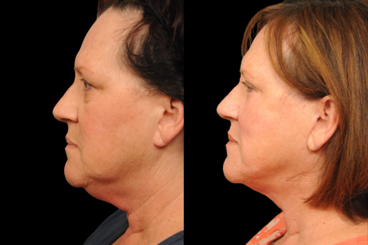 Changes Rapid Lift  Before & After Gallery - Patient 136713 - Image 2