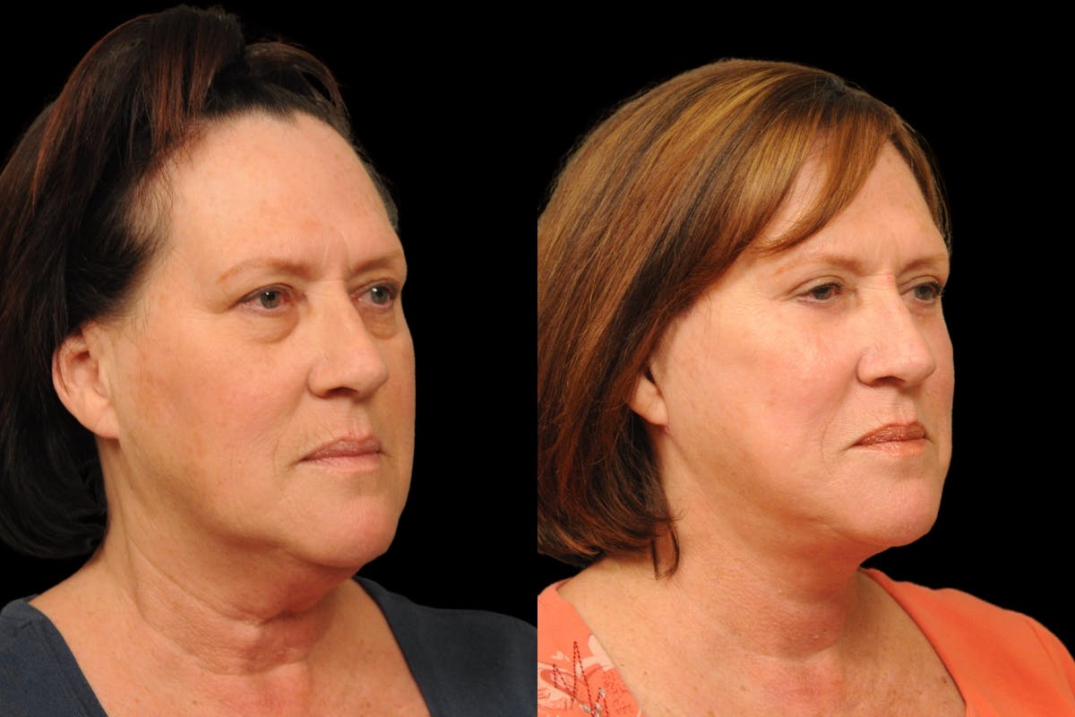 Changes Rapid Lift  Before & After Gallery - Patient 136713 - Image 3