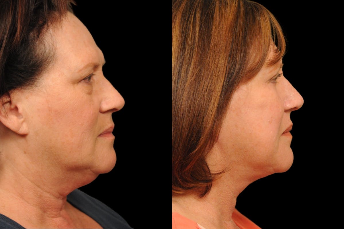 Changes Rapid Lift  Before & After Gallery - Patient 136713 - Image 4