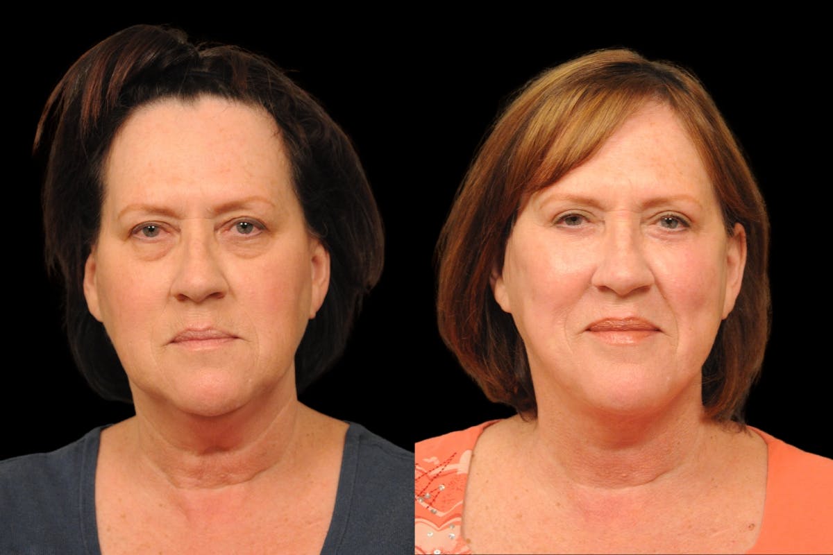 Changes Rapid Lift  Before & After Gallery - Patient 136713 - Image 5