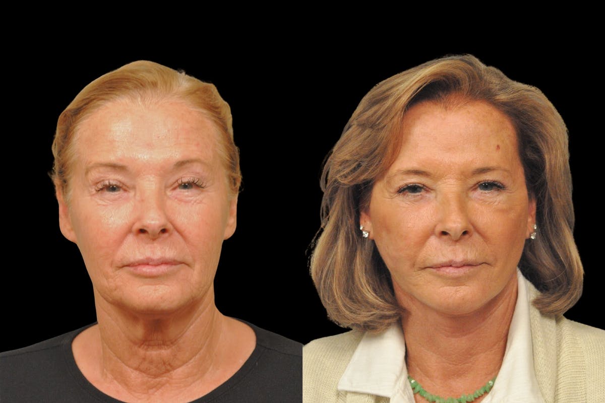 Changes Rapid Lift  Before & After Gallery - Patient 318295 - Image 5