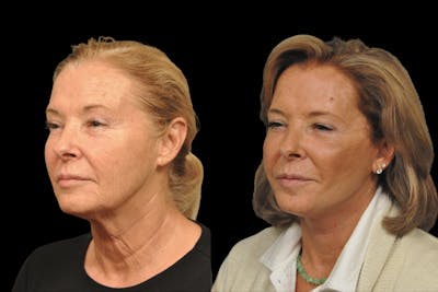 Changes Rapid Lift  Before & After Gallery - Patient 318295 - Image 1