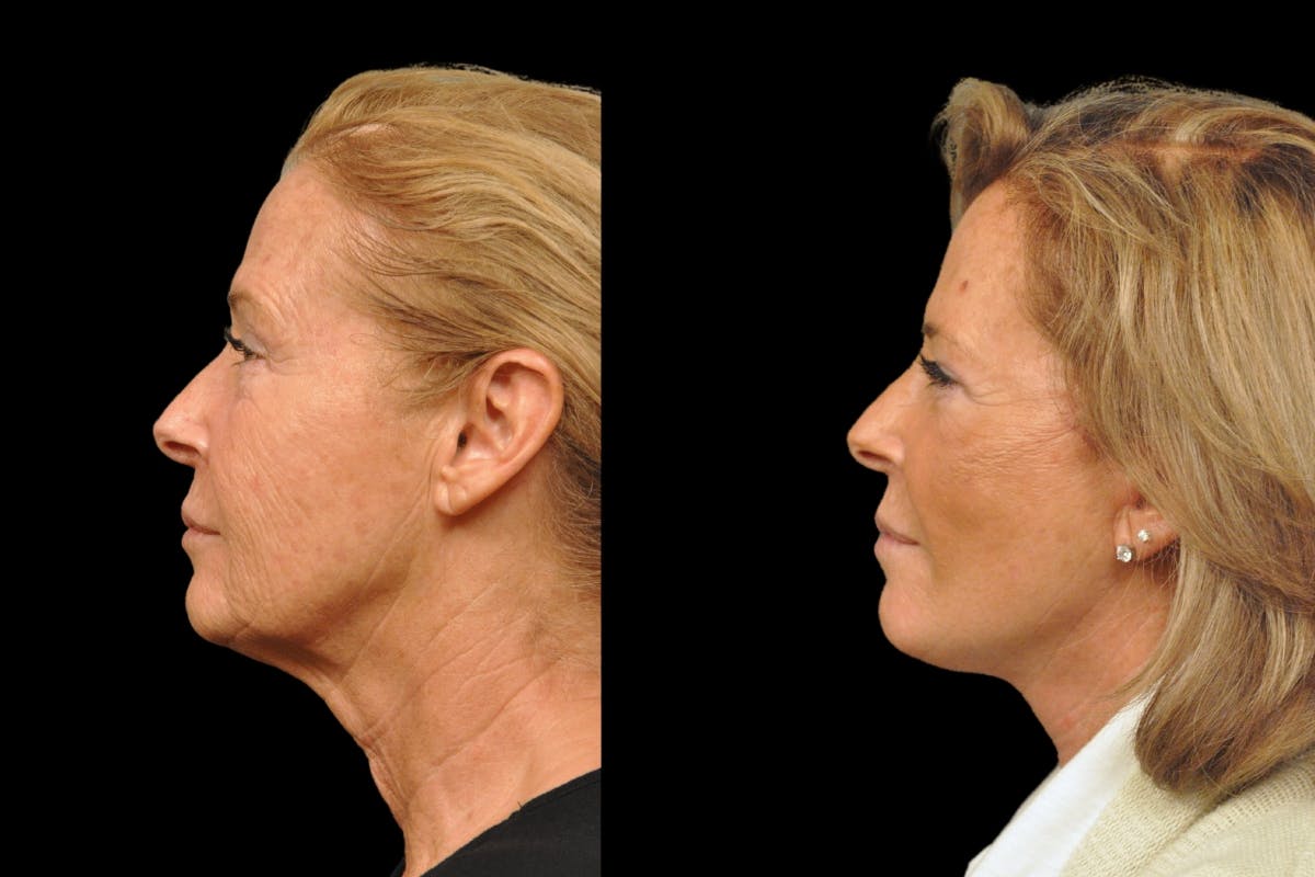 Changes Rapid Lift  Before & After Gallery - Patient 318295 - Image 2
