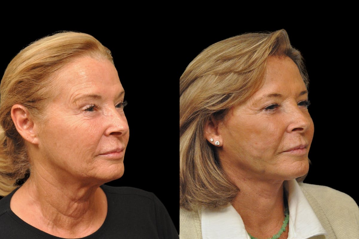 Changes Rapid Lift  Before & After Gallery - Patient 318295 - Image 3