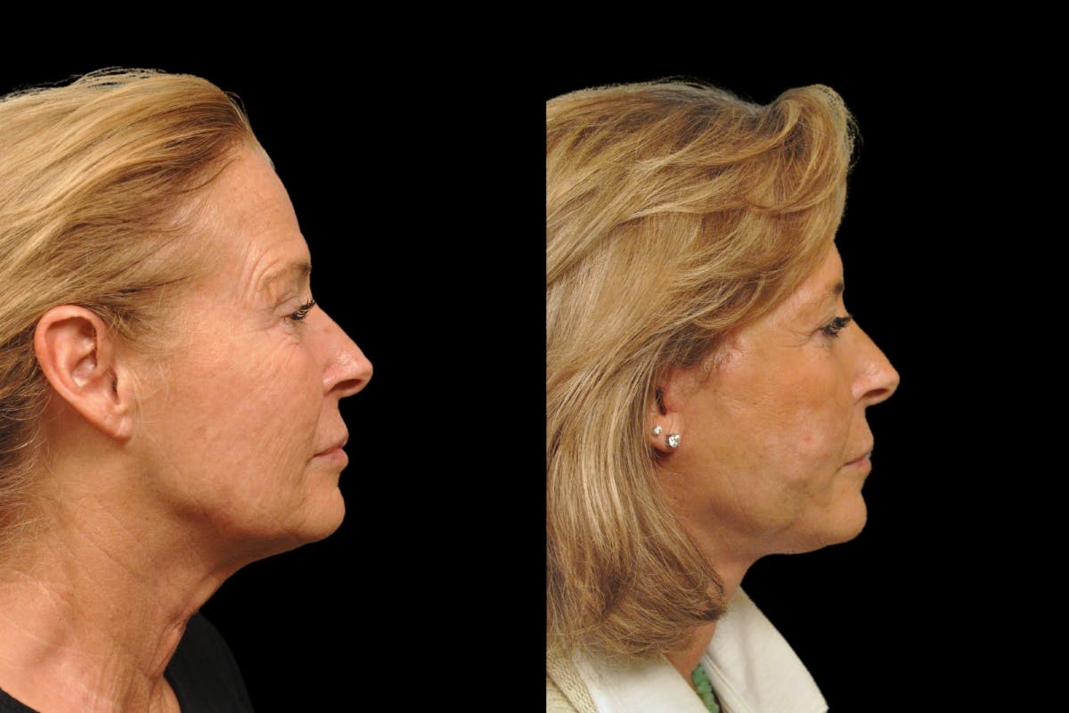 Changes Rapid Lift  Before & After Gallery - Patient 318295 - Image 4