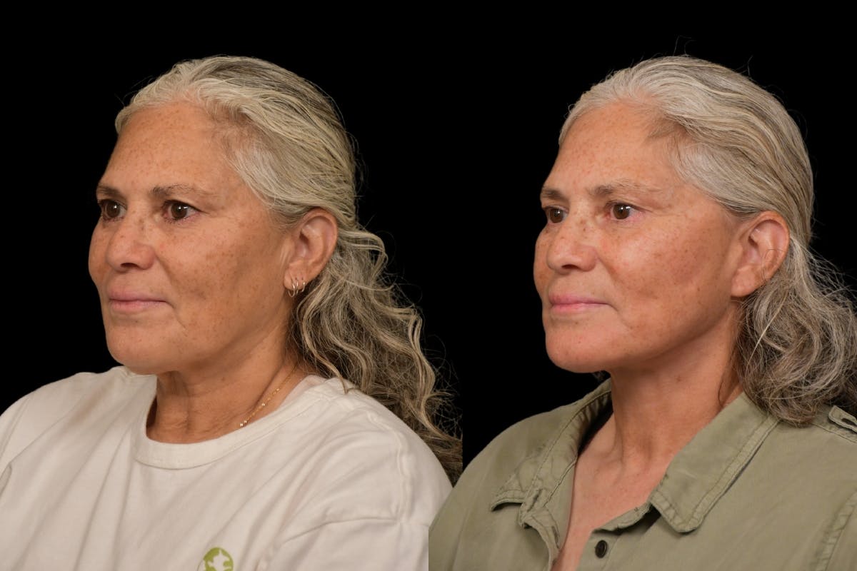 Changes Rapid Lift  Before & After Gallery - Patient 327857 - Image 1