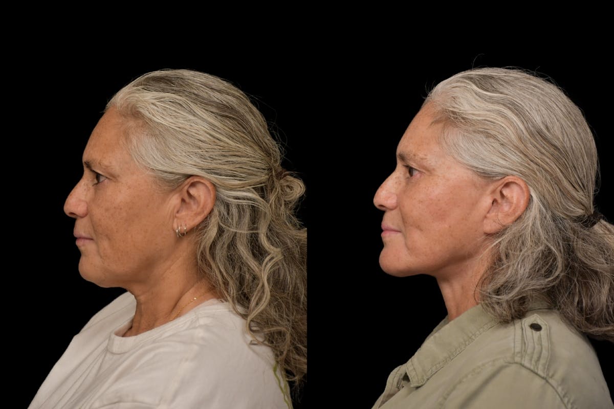 Changes Rapid Lift  Before & After Gallery - Patient 327857 - Image 2