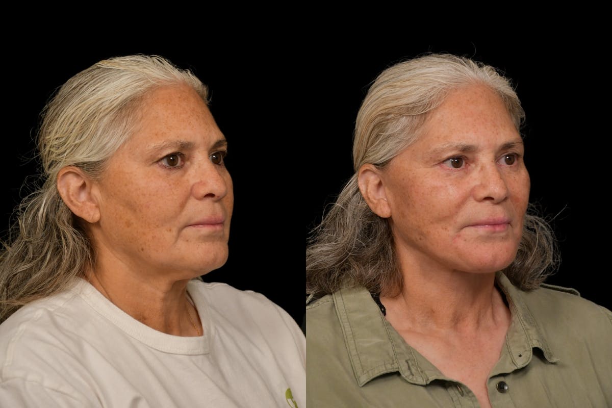 Changes Rapid Lift  Before & After Gallery - Patient 327857 - Image 3