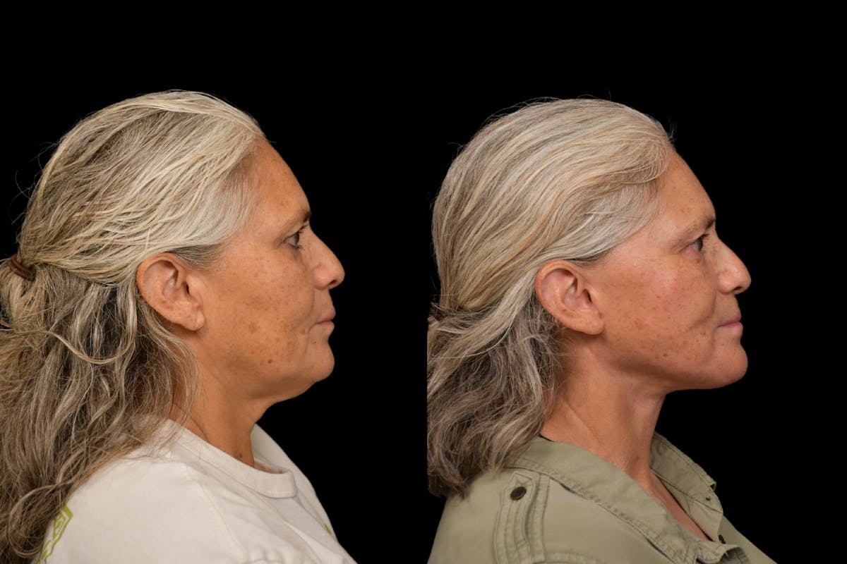 Changes Rapid Lift  Before & After Gallery - Patient 327857 - Image 4