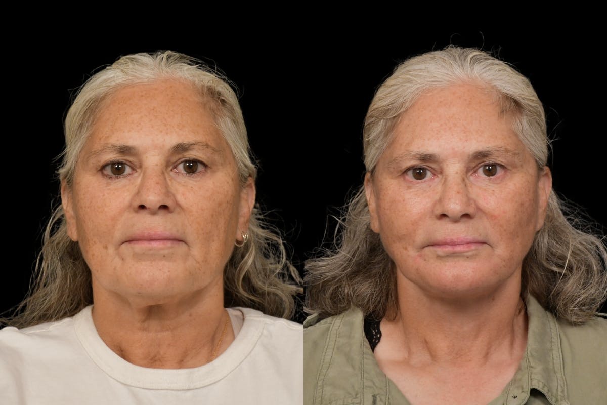Changes Rapid Lift  Before & After Gallery - Patient 327857 - Image 5