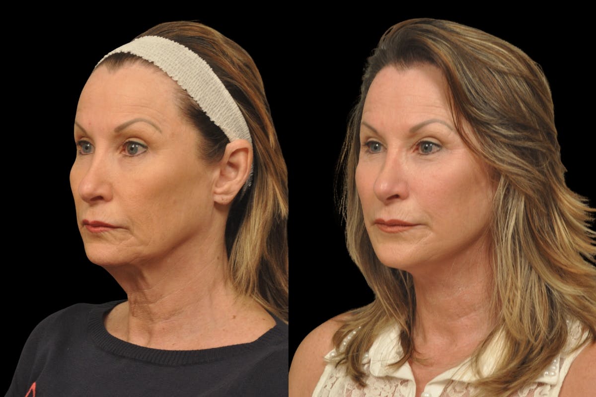 Changes Rapid Lift  Before & After Gallery - Patient 135502 - Image 1