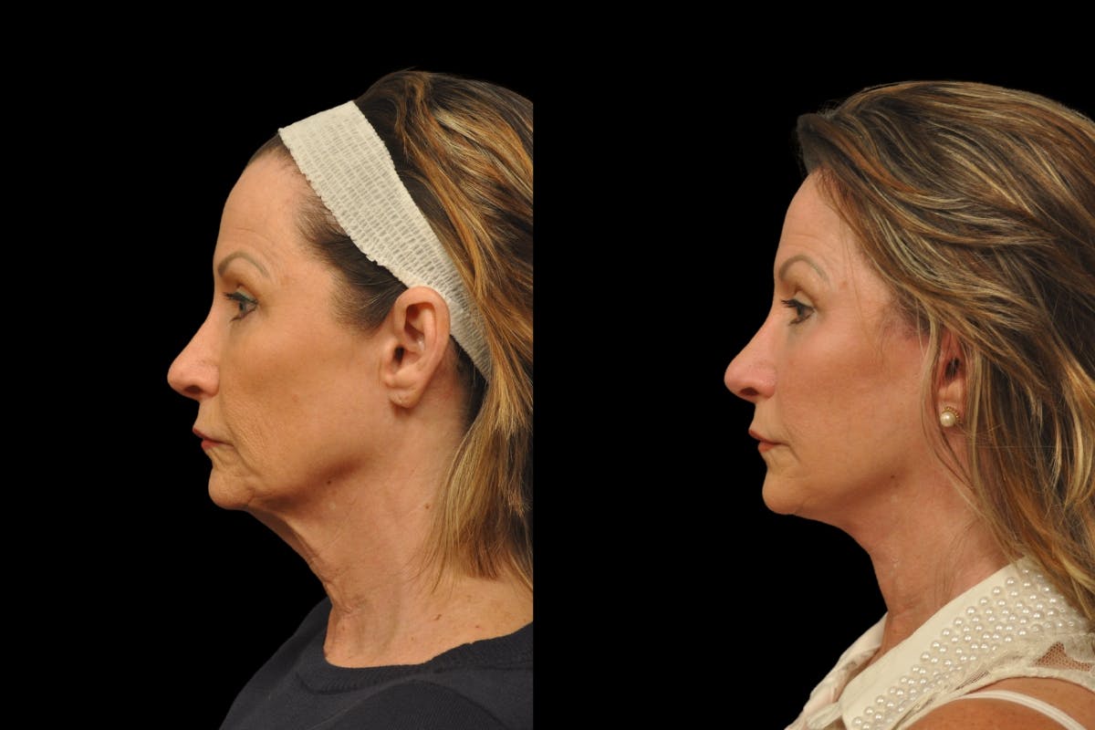 Changes Rapid Lift  Before & After Gallery - Patient 135502 - Image 2