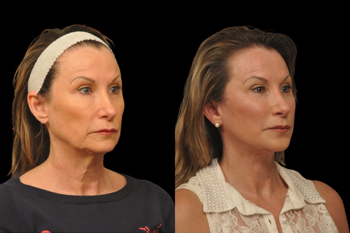 Changes Rapid Lift  Before & After Gallery - Patient 135502 - Image 3