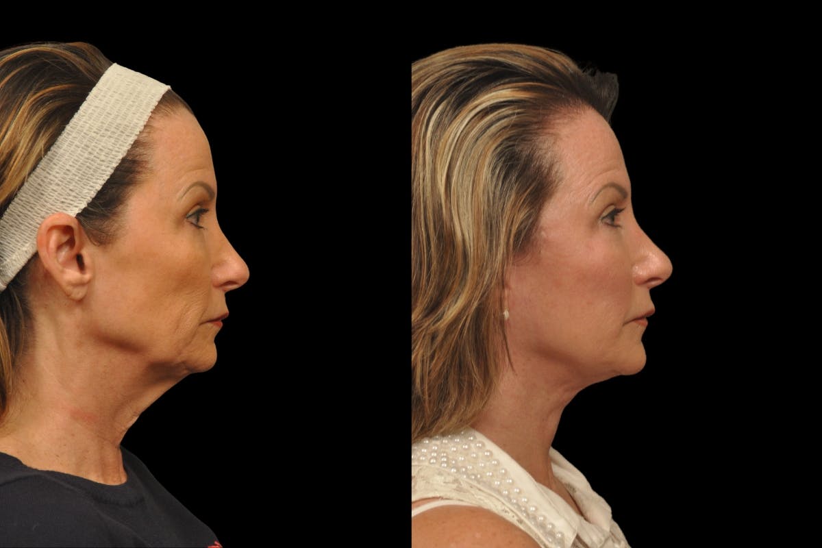 Changes Rapid Lift  Before & After Gallery - Patient 135502 - Image 4