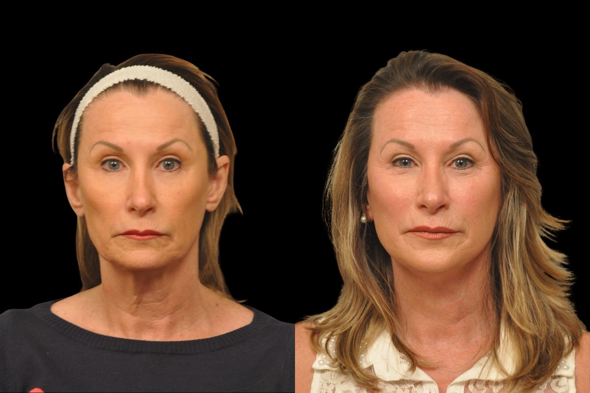 Changes Rapid Lift  Before & After Gallery - Patient 135502 - Image 5