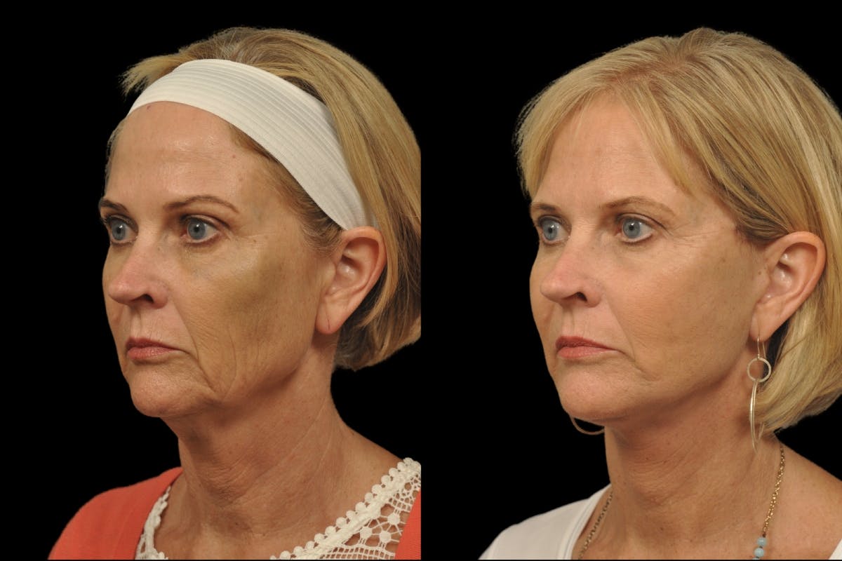Changes Rapid Lift  Before & After Gallery - Patient 279419 - Image 1