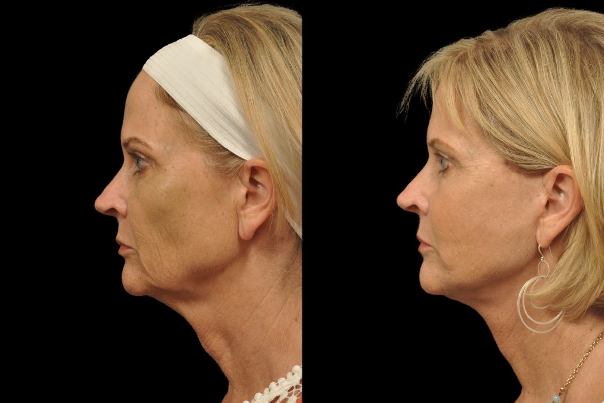 Changes Rapid Lift  Before & After Gallery - Patient 279419 - Image 2