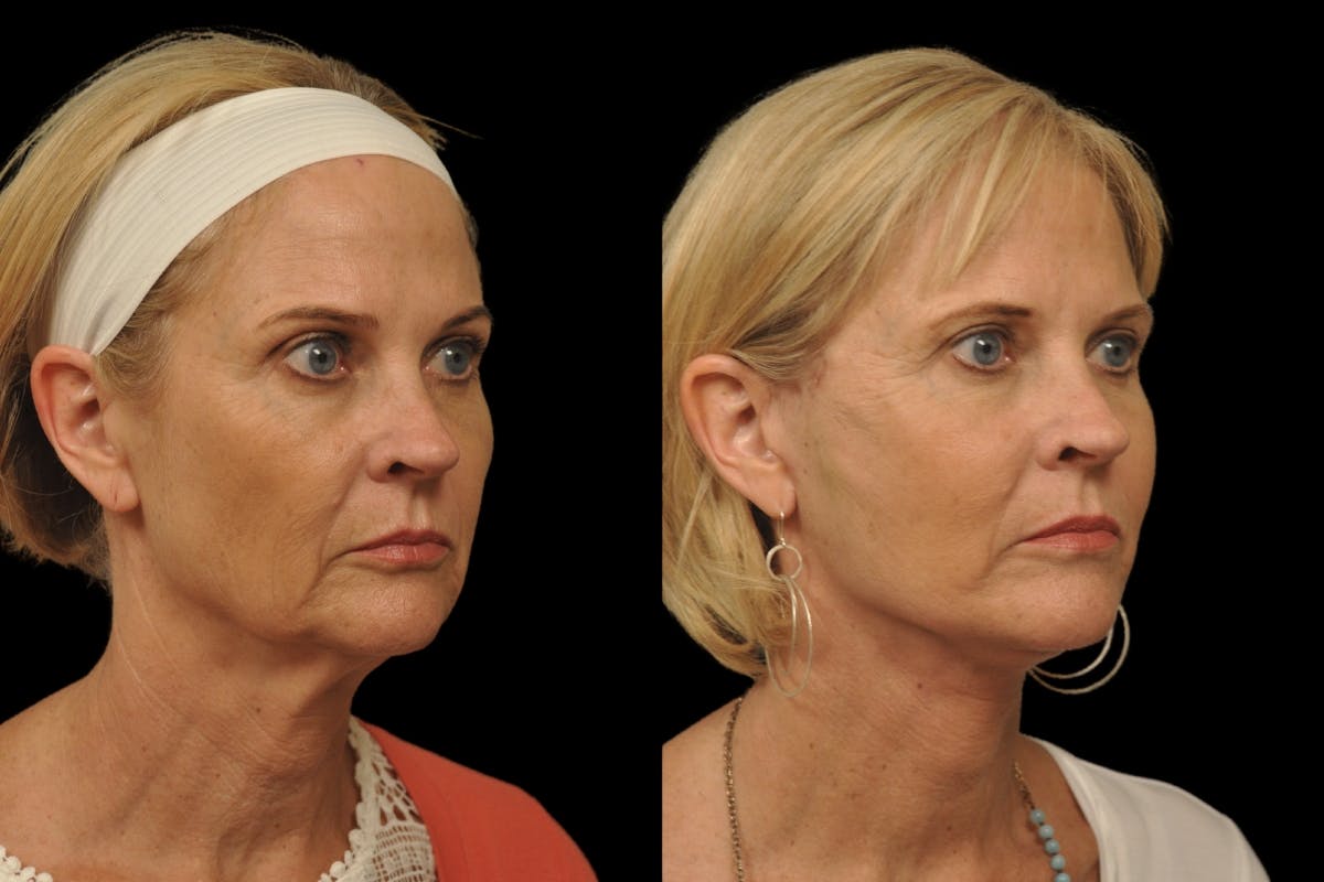 Changes Rapid Lift  Before & After Gallery - Patient 279419 - Image 3