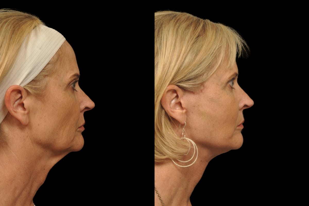Changes Rapid Lift  Before & After Gallery - Patient 279419 - Image 4