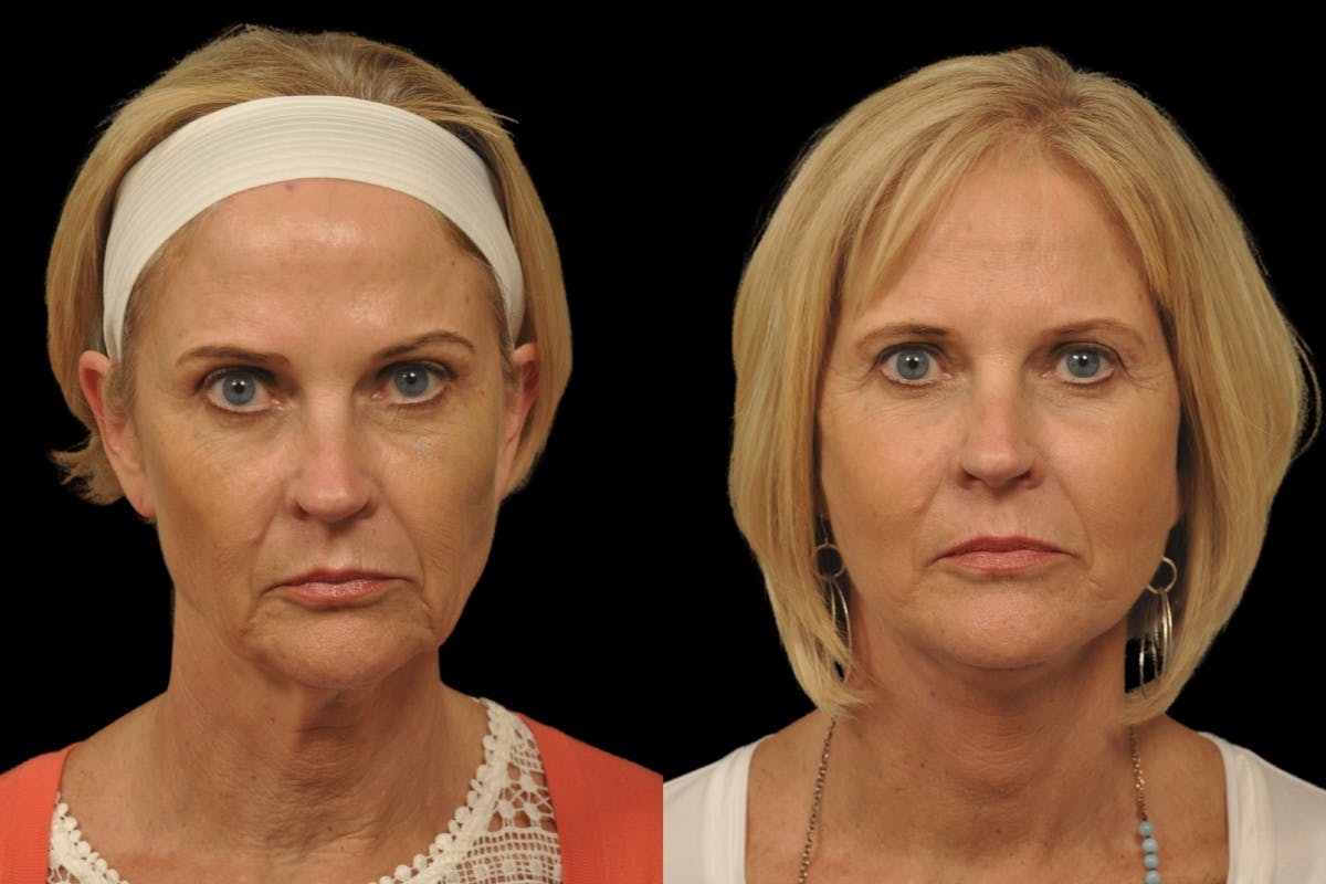 Changes Rapid Lift  Before & After Gallery - Patient 279419 - Image 5