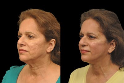 Changes Rapid Lift  Before & After Gallery - Patient 284332 - Image 1