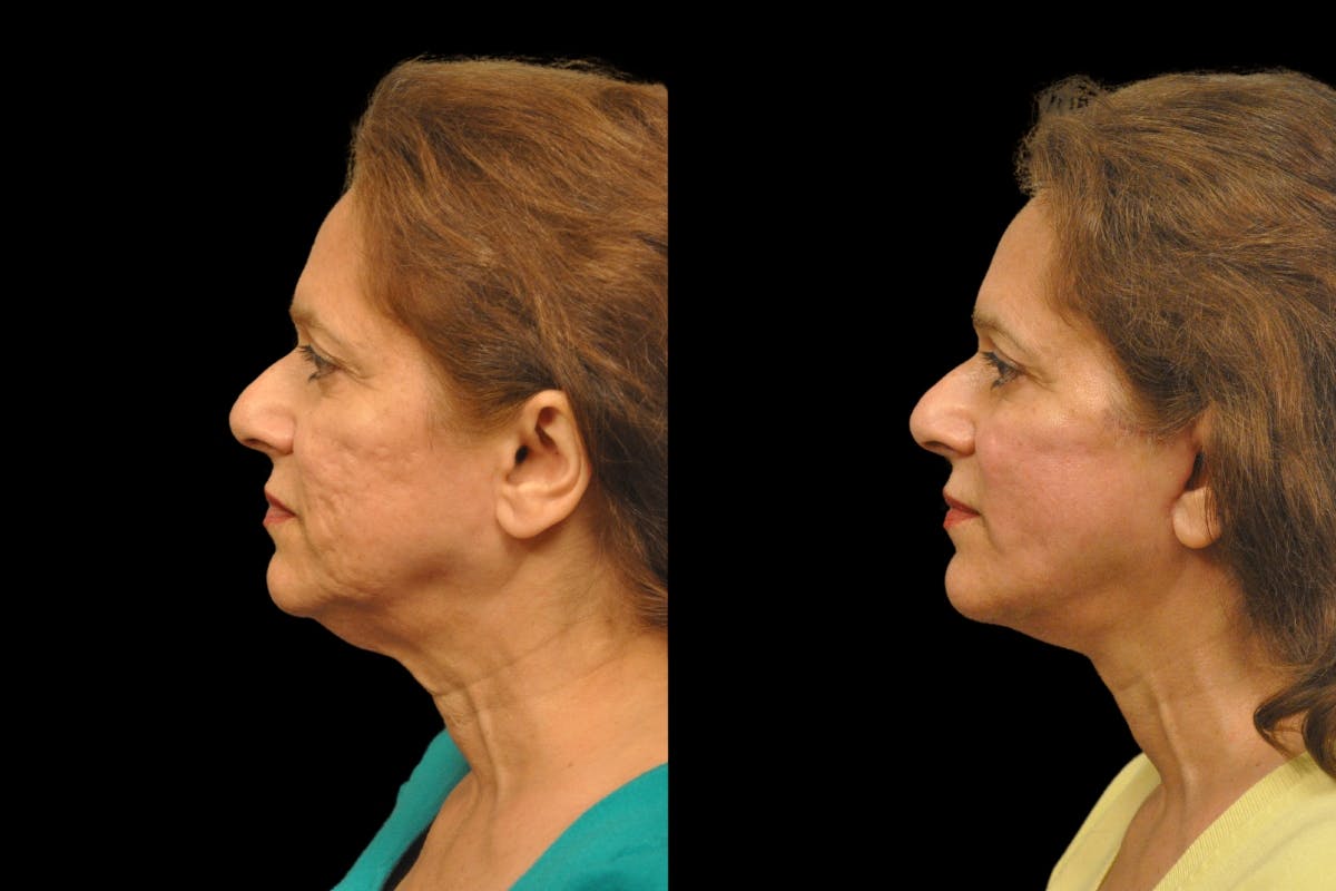 Changes Rapid Lift  Before & After Gallery - Patient 284332 - Image 2