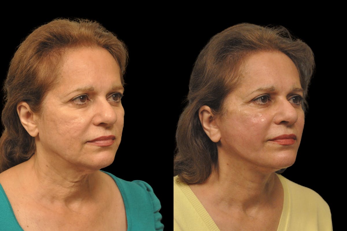 Changes Rapid Lift  Before & After Gallery - Patient 284332 - Image 3