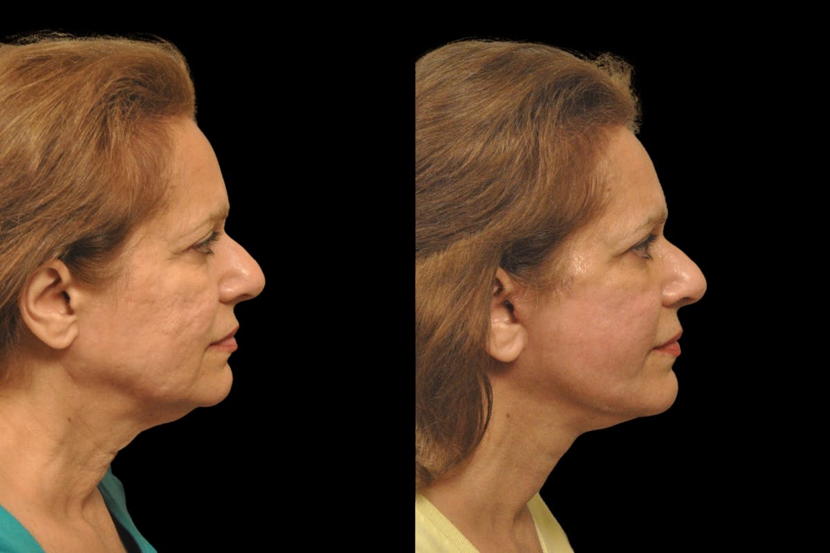 Changes Rapid Lift  Before & After Gallery - Patient 284332 - Image 4