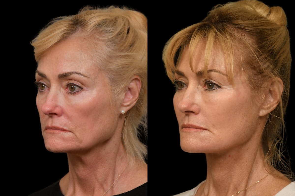 Changes Rapid Lift  Before & After Gallery - Patient 323292 - Image 1