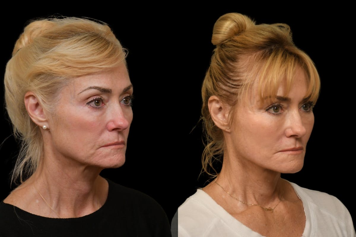 Changes Rapid Lift  Before & After Gallery - Patient 323292 - Image 3