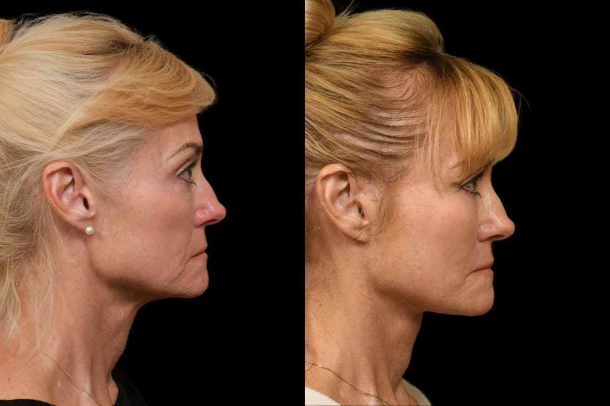 Changes Rapid Lift  Before & After Gallery - Patient 323292 - Image 4