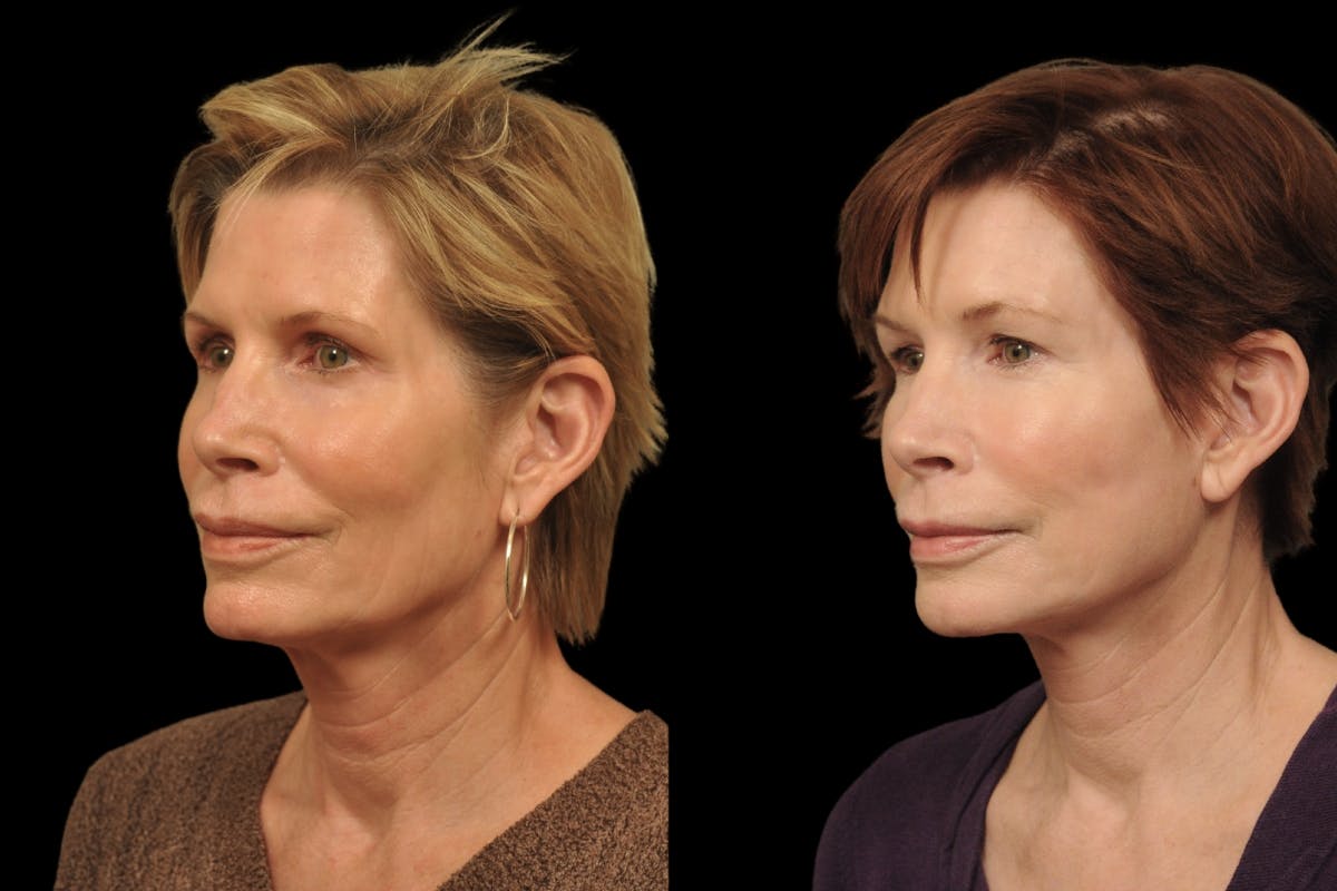 Changes Rapid Lift  Before & After Gallery - Patient 212241 - Image 1