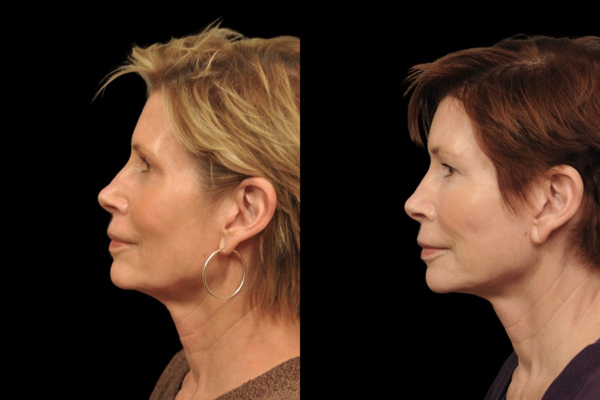 Changes Rapid Lift  Before & After Gallery - Patient 212241 - Image 2