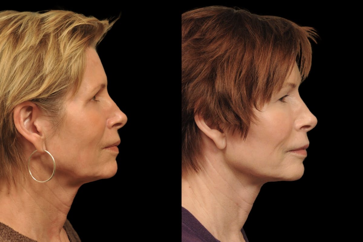 Changes Rapid Lift  Before & After Gallery - Patient 212241 - Image 4