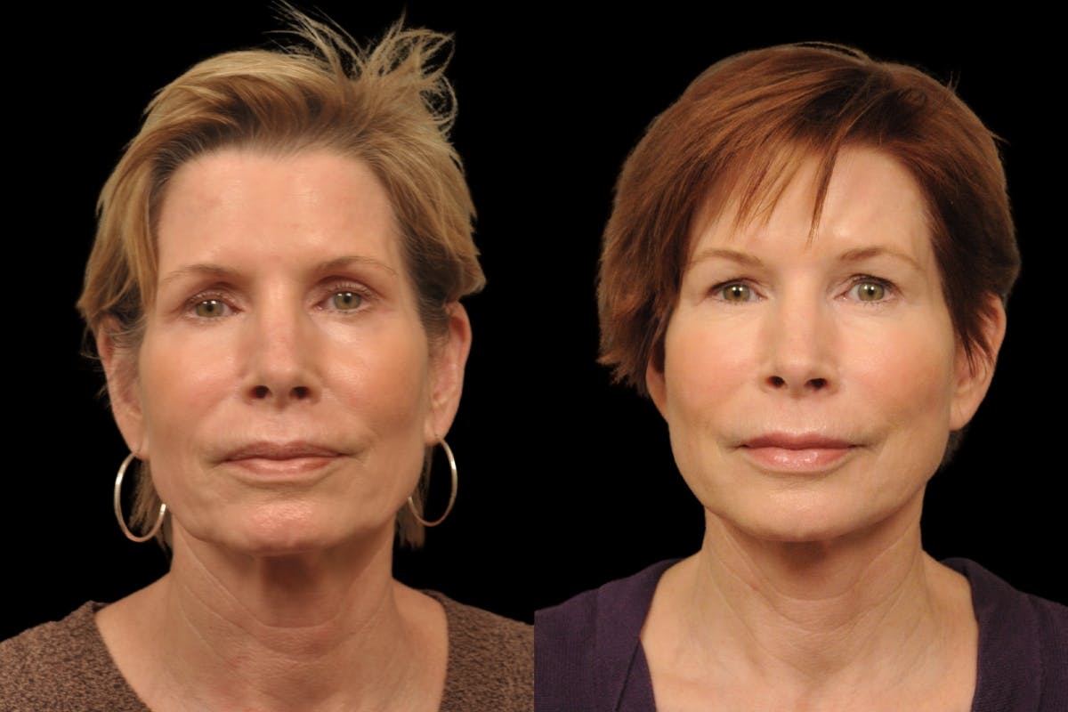 Changes Rapid Lift  Before & After Gallery - Patient 212241 - Image 5