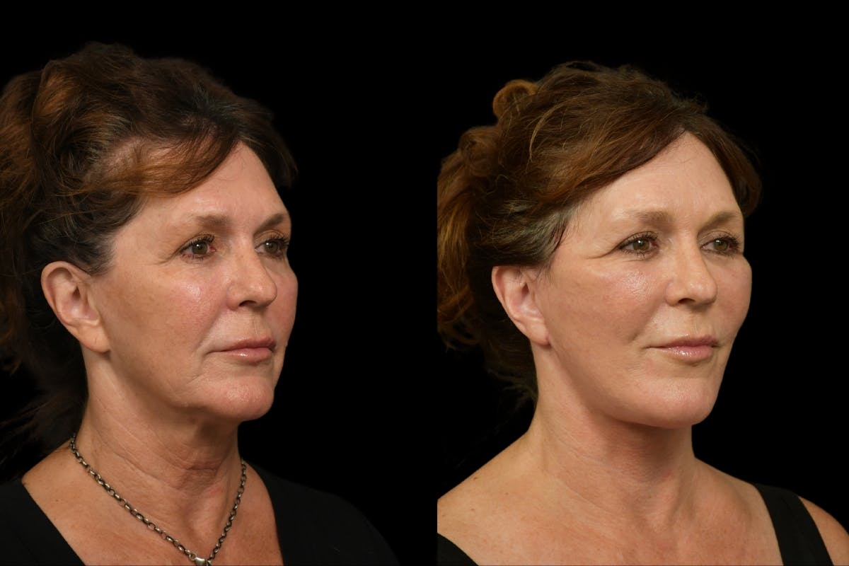 Changes Rapid Lift  Before & After Gallery - Patient 254566 - Image 3
