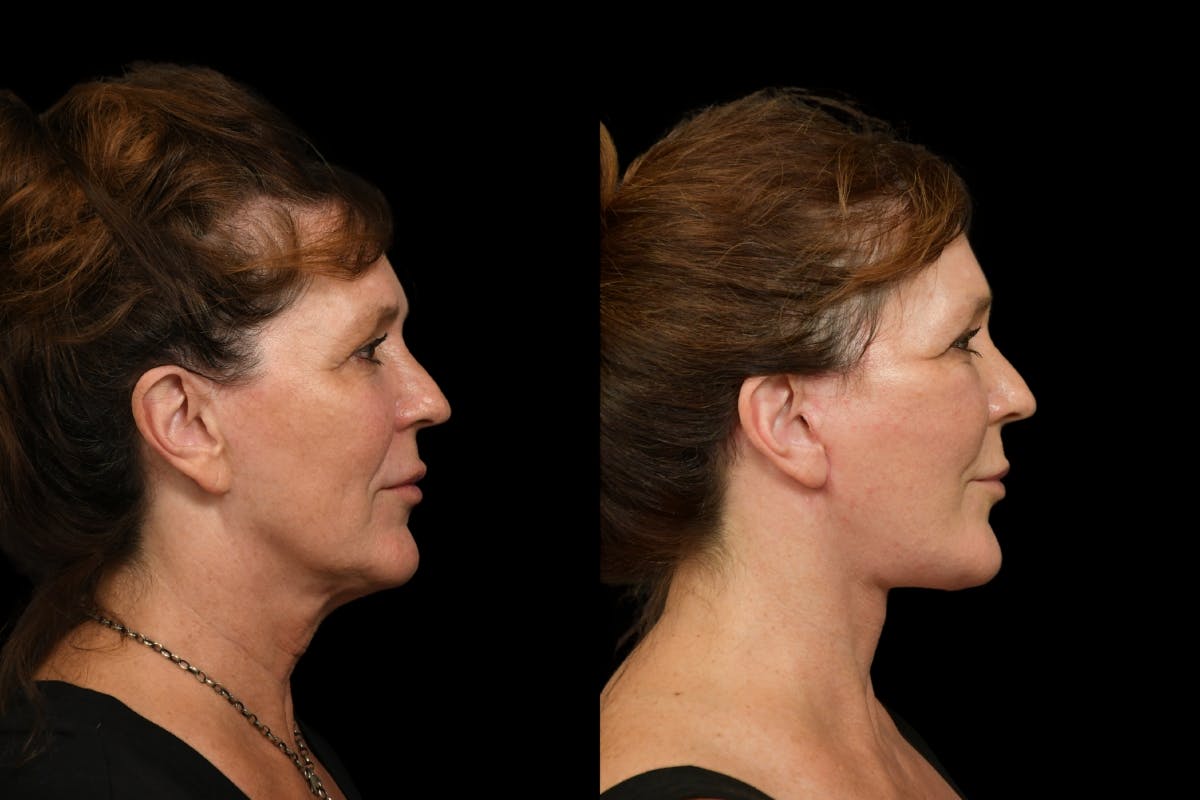Changes Rapid Lift  Before & After Gallery - Patient 254566 - Image 4