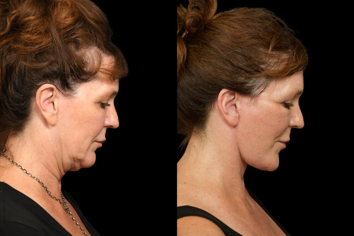 Changes Rapid Lift  Before & After Gallery - Patient 254566 - Image 5