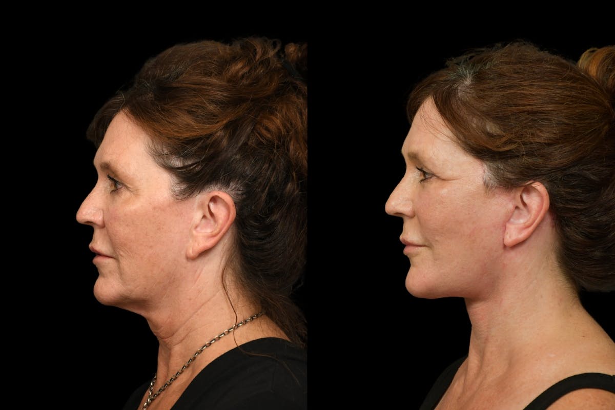 Changes Rapid Lift  Before & After Gallery - Patient 254566 - Image 2