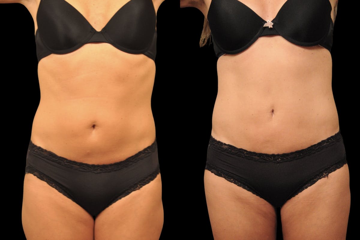 Tummy Tuck Before & After Gallery - Patient 271654 - Image 1