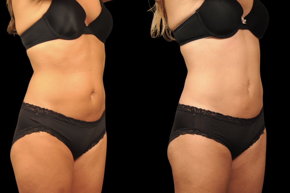 Tummy Tuck Before & After Gallery - Patient 271654 - Image 2