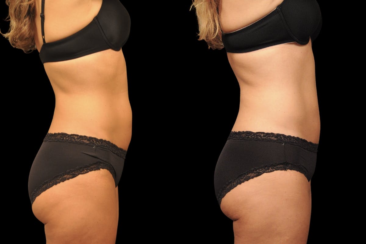 Tummy Tuck Before & After Gallery - Patient 271654 - Image 3