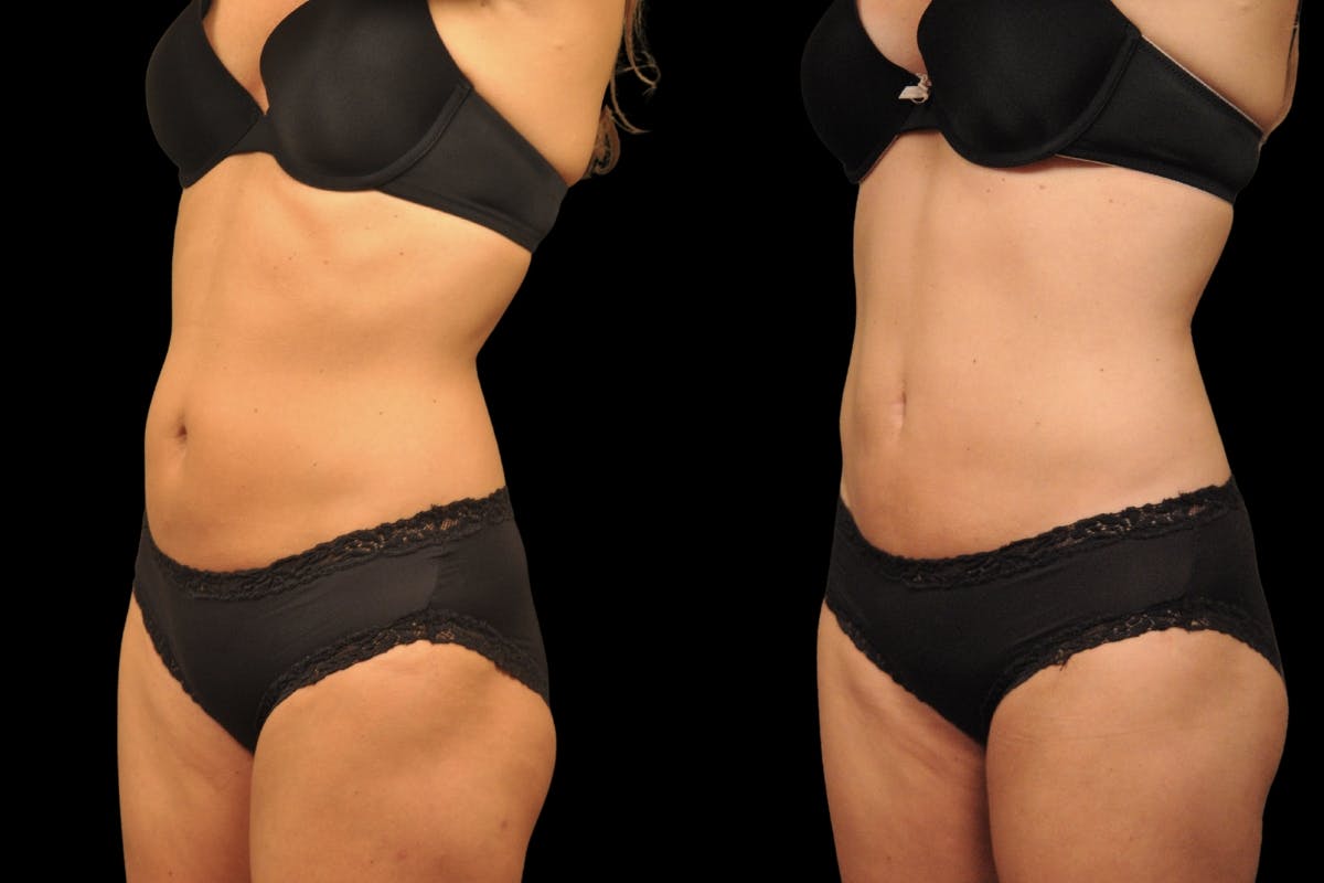Tummy Tuck Before & After Gallery - Patient 271654 - Image 4