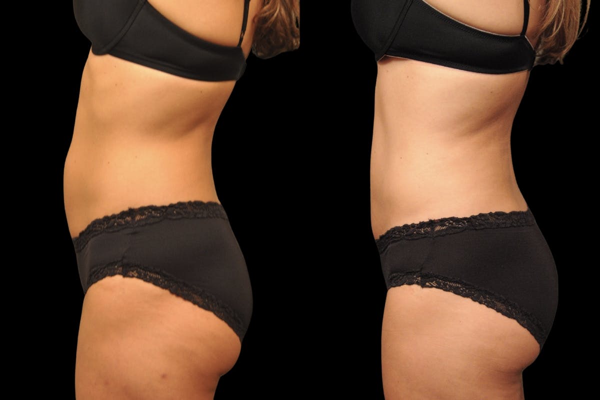 Tummy Tuck Before & After Gallery - Patient 271654 - Image 5