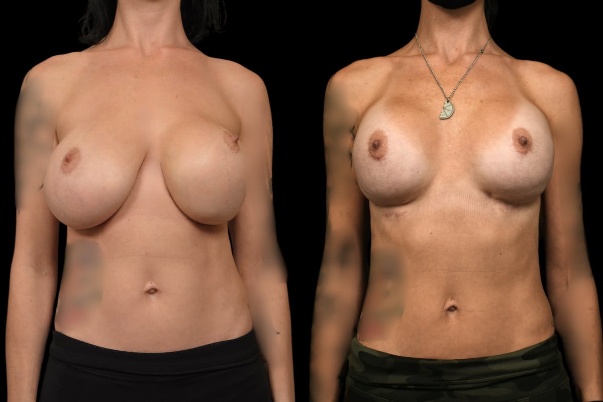 Breast Revision Before & After Gallery - Patient 705844 - Image 1