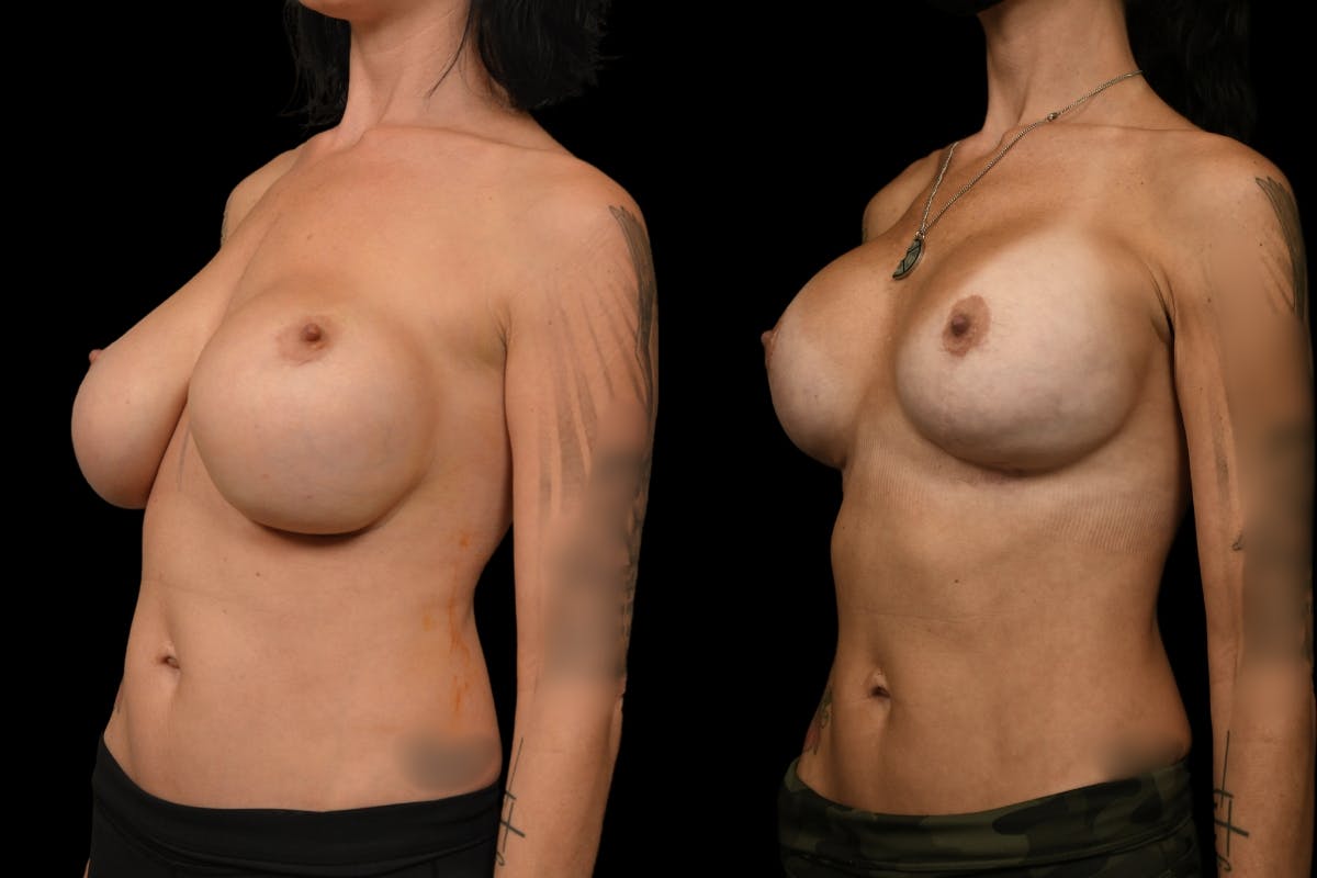 Breast Revision Before & After Gallery - Patient 705844 - Image 2