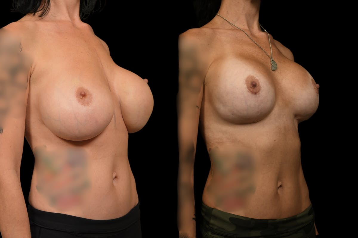 Breast Revision Before & After Gallery - Patient 705844 - Image 5